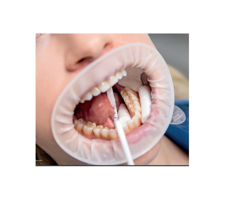 Abridor De Boca 3d Regular Unidade Optragate Ivoclar