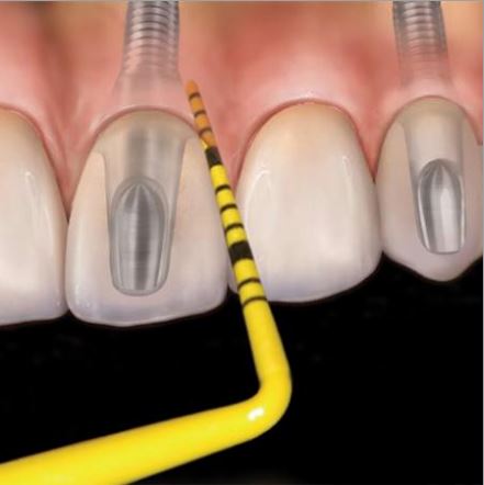 Kit De Sonda Milimetrada C- 1 Cabo + 7 Pontas Pcv12kit6 Hu-friedy